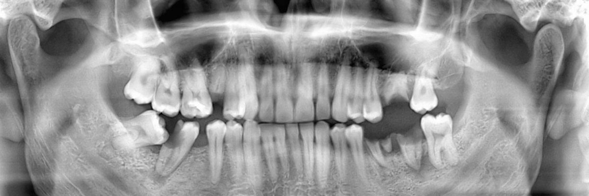 Fort Washington Options for Replacing Missing Teeth