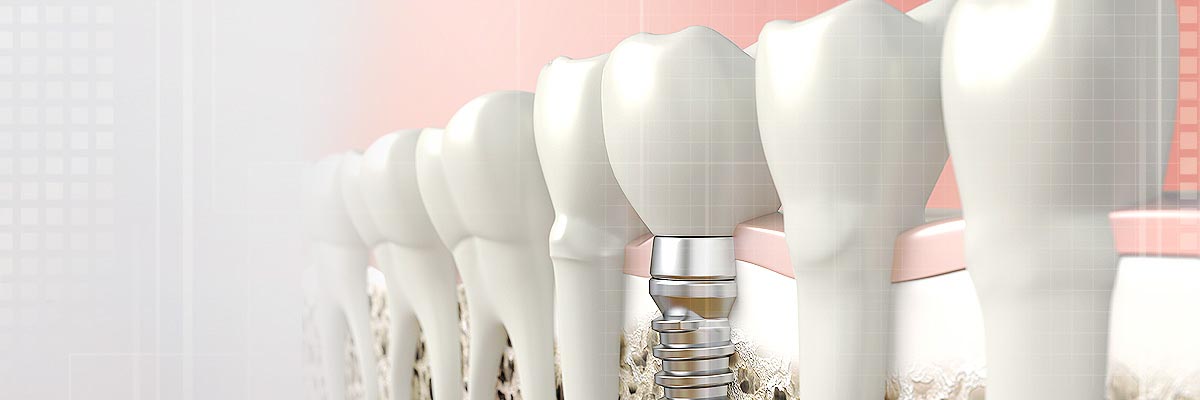 Fort Washington Implant Dentist