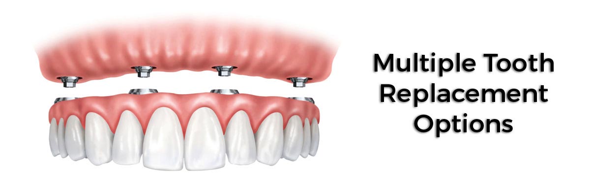 Fort Washington Multiple Teeth Replacement Options